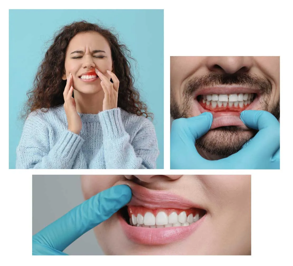 gum graft