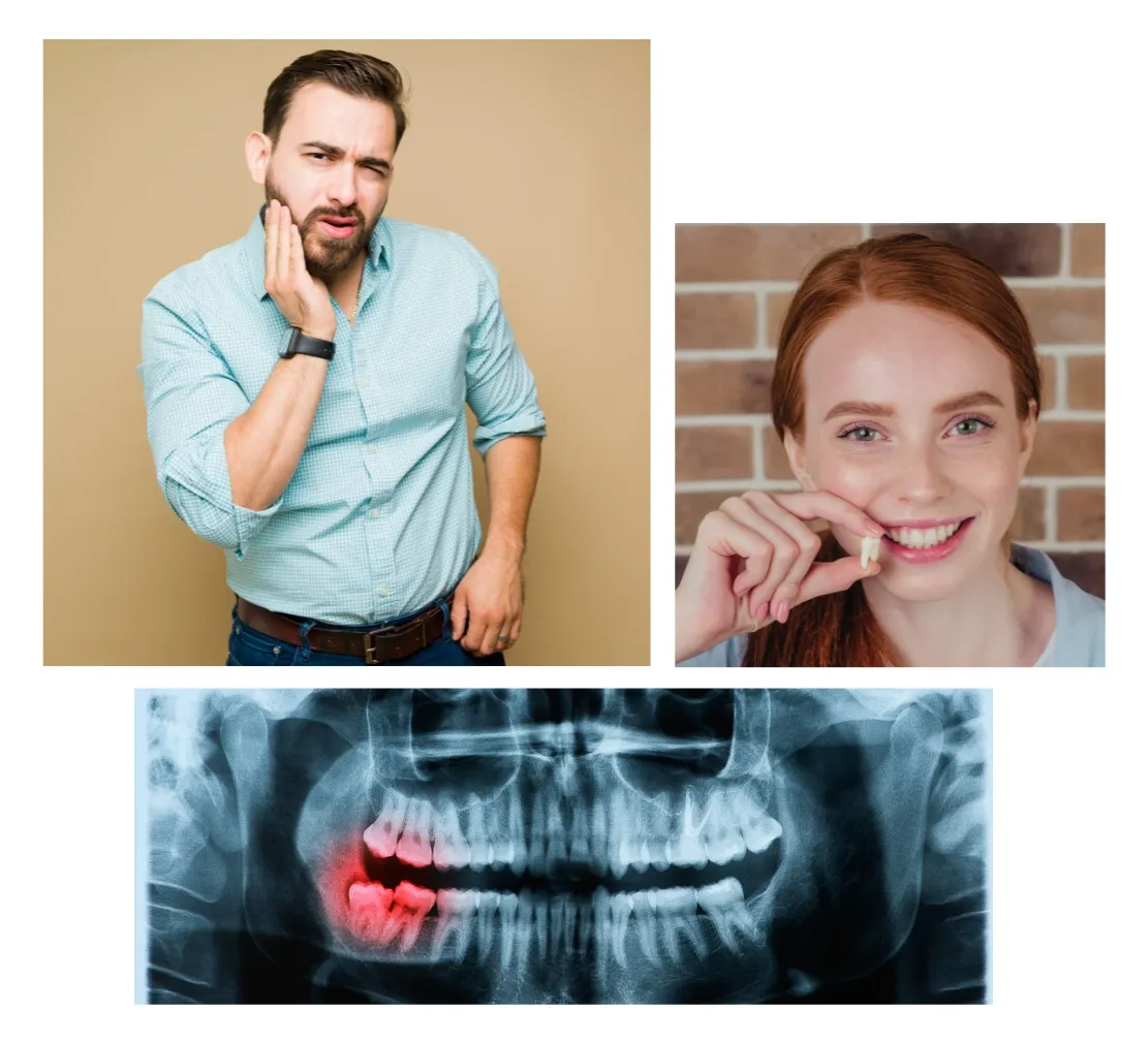 extraction dent de sagesse intervention