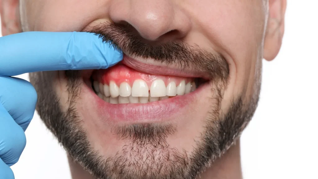 how to treat gingivitis symptoms